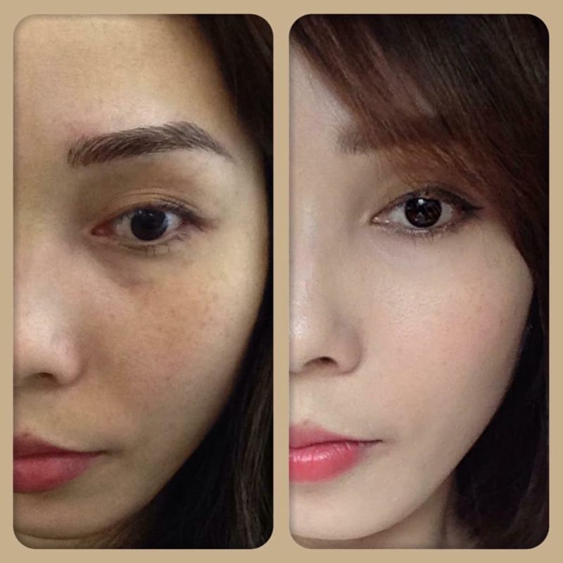 Face Đặt Trị Nám - Tàng Nhang